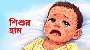 হামের উপসর্গে ২৪ ঘণ্টায় প্রাণ গেল পাঁচজনের